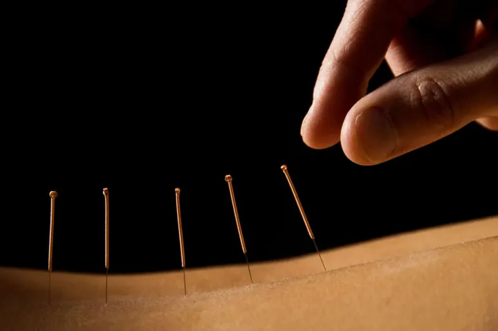 Fine acupuncture needles placed along a patient's back