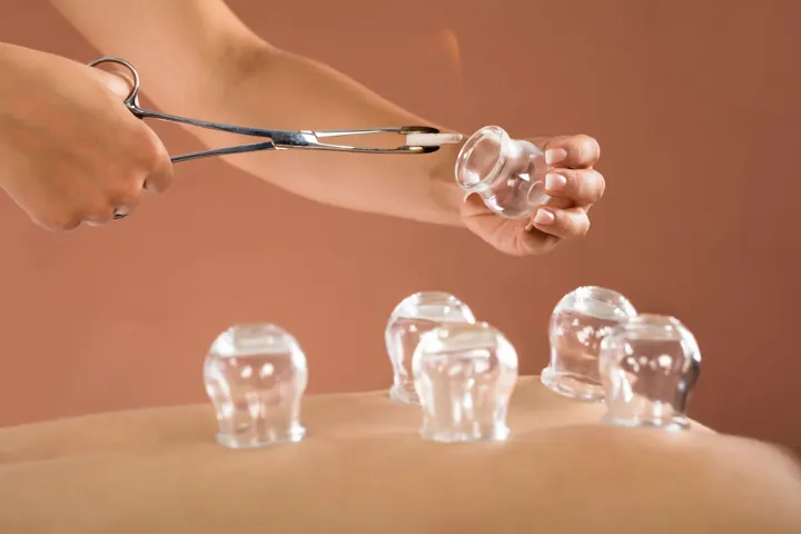 Glass cupping cups on a patient's back